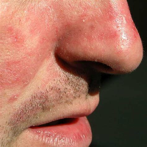 Dermatite Seborroica Viso Sintomi Cause E Trattamento