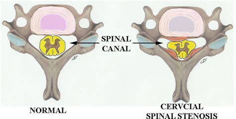 Cervical Spinal Stenosis