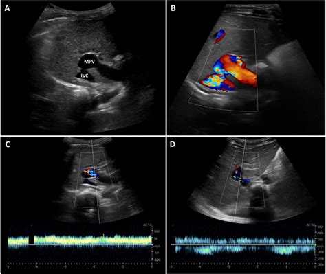 Ultrasonography With Color And Spectral Doppler A And B