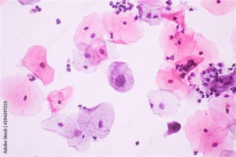 Fototapeta View In Microscopic Of Abnormal Human Cervix Cellssquamous