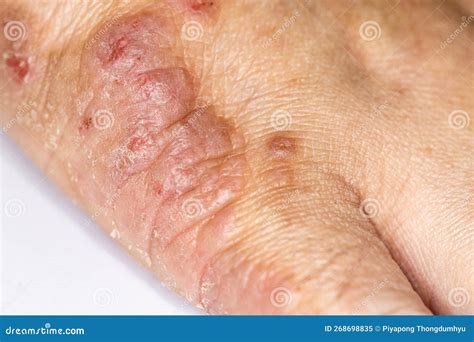 Background Of Human Skin With Dust Mite Allergy Stock Image Image Of