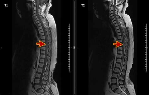 Cureus Acute Spinal Extradural Hematoma And Cord Compression Case