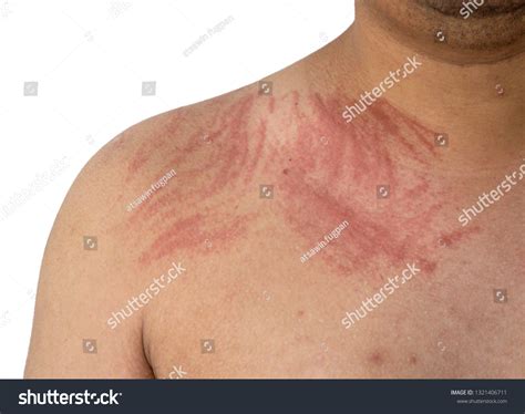 Dermographism Dermatographia On Skin Stock Photo 1321406711 Shutterstock