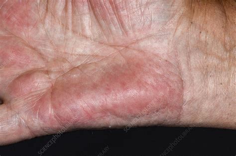 Liver Palms Stock Image C0549470 Science Photo Library