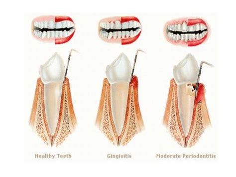 The Oral Diseases Gingivitis