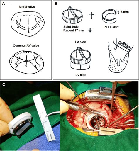 Operative Technique Of Supra Annular Mechanical Valve Replacement A