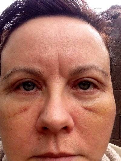 Swelling After Facelift Treatment Picture 1 Facelift Info Prices