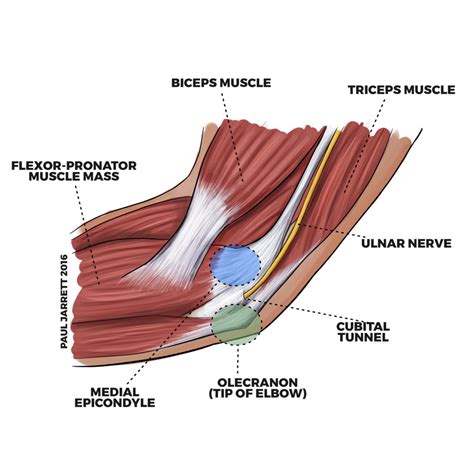 Ulnar Neuropathy At The Elbow Cubital Tunnel Syndrome Murdoch Orthopaedic Clinic