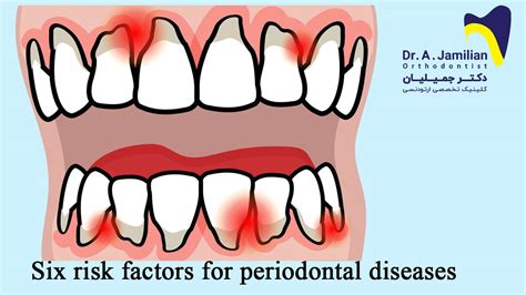 Six Risk Factors For Periodontal Diseases Risk Factors For Periodontal Disease Dr Jamilian