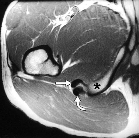 Hamstring Muscle Complex An Imaging Review Radiographics