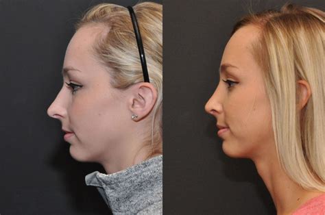 Rhinoplasty Nose Reshaping Photos Cincinnati Oh Patient 6822