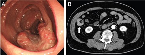 Routine screenings help doctors detect colon cancer early on—even before you develop symptoms. Serum anti-p53 antibody as a tumour marker for colorectal ...