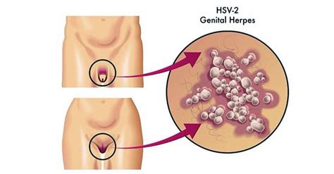 Complete information about herpes simplex type i, including signs and symptoms; Herpes Simplex Virus: Causes & Treatments Symptoms | Premier Clinic