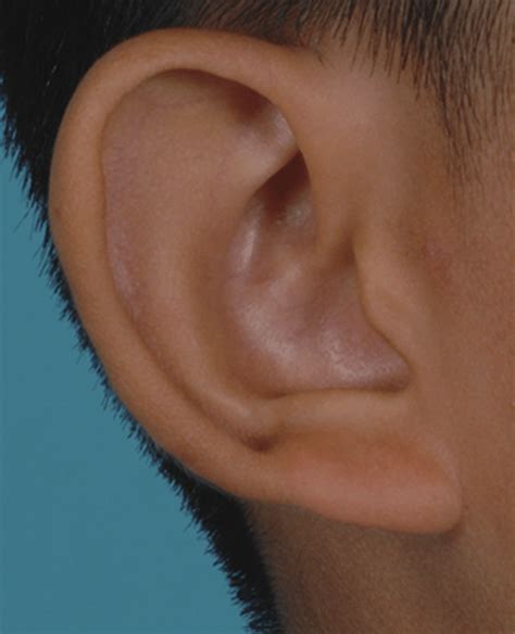 Photograph Of The Patients Right Ear Postoperative Left Ear Shown In