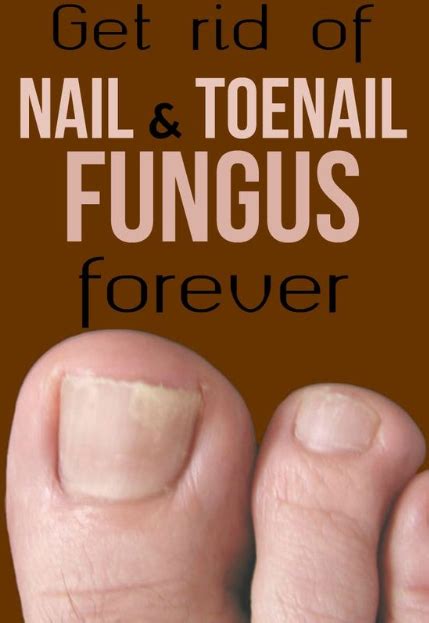 Get Rid Of Nail And Toenail Fungus Forever Toenail Fungal Infection