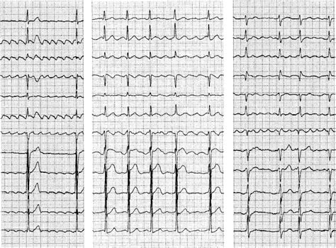 The 12 Lead Ecg Shows A Typical Atrial Flutter With Regular And