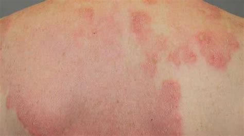 Rheumatoid Arthritis Rashes Pictures Symptoms And Treatments