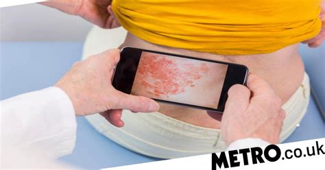 Coronavirus Symptoms Could Skin Rashes Be A Sign Of Covid 19 Metro News