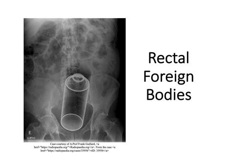 Emergency Medicine Educationrectal Foreign Bodies Archives