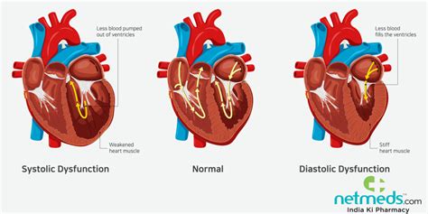 Heart Failure Symptoms Causes Types And Treatment