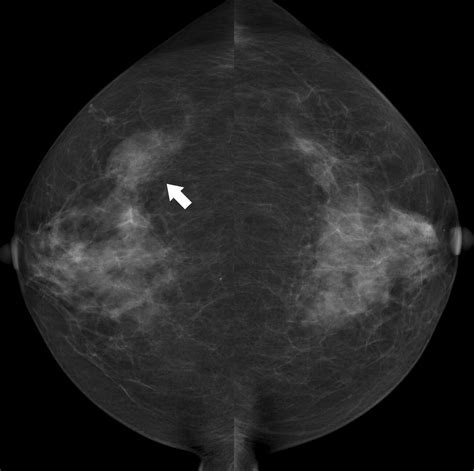 Asymmetric Mammographic Findings Based On The Fourth Edition Of Bi Rads