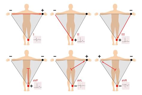 12 Lead Ecg Placement Guide With Illustrations With