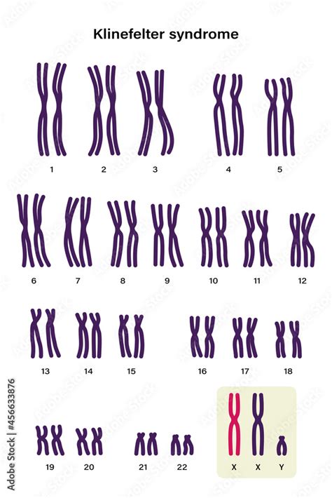 Human Karyotype Of Klinefelter Syndrome Klinefelter S KS Or XXY