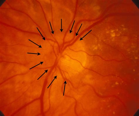 Optic Disk Blind Spot Optic Nerve Head Optic Papilla