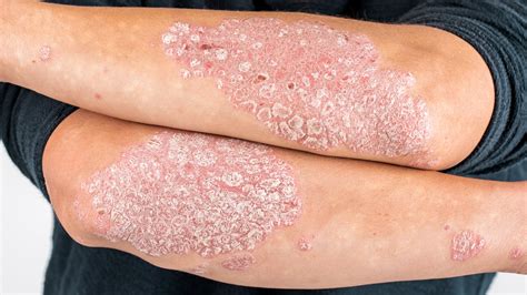 How Severe Is Your Psoriasis Mypsoriasis