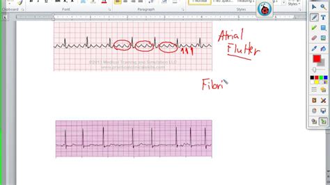 Ekg Normal And Abnormal Youtube