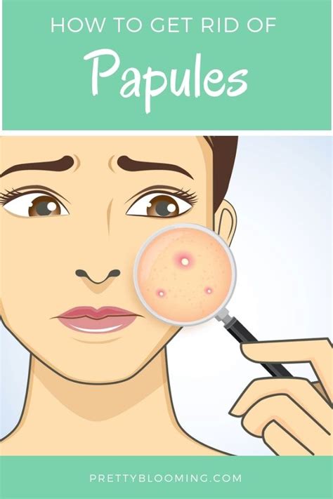 How To Treat Papules Acne Naturally