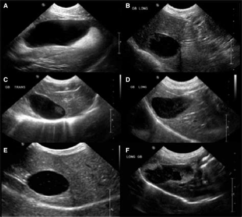 Representative Ultrasound Images Of The Gallbladder Gb In Dogs With