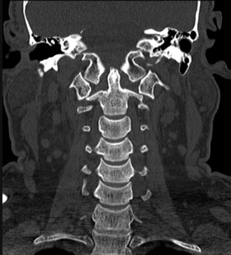 Palm 801 Radiology Of The Spine And Upper Limb Flashcards Quizlet