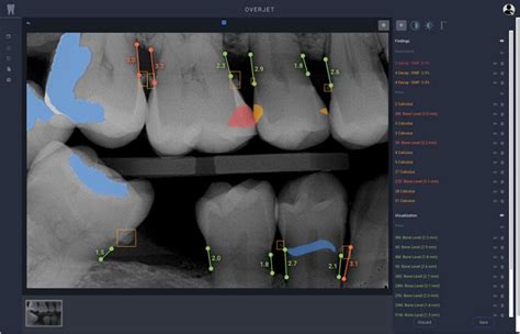 How AI Helps Diagnose Dental Problems Electronics360