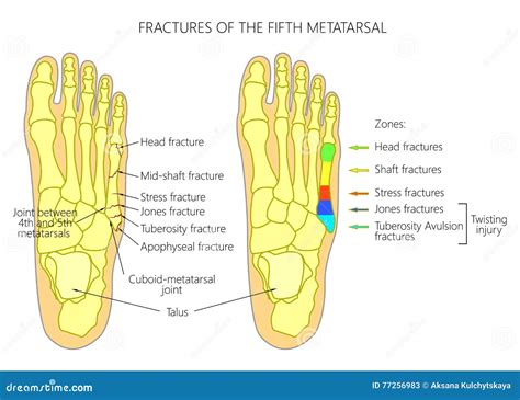 Fractures Of The 5th Metatarsal Stock Vector Illustration Of