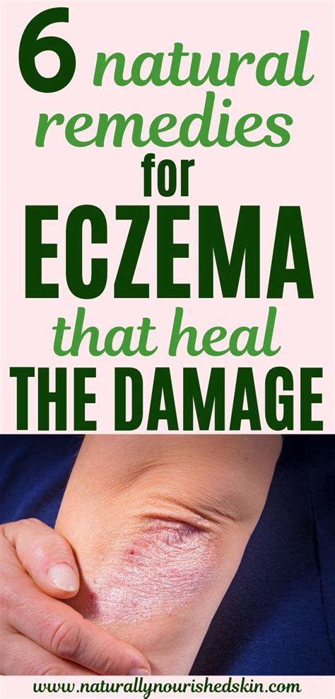 6 Natural Remedies For Eczema That Heal The Damage Natural Eczema