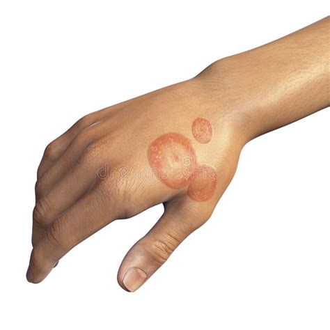 Fungal Infection On A Man S Hand Tinea Manuum Stock Illustration