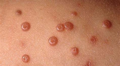 Molluscum Contagiosum Pictures Causes Symptoms Treatment Virus Stages Diseases Pictures