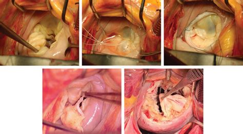 Mitral valve repair for degenerative mitral valve disease: surgical