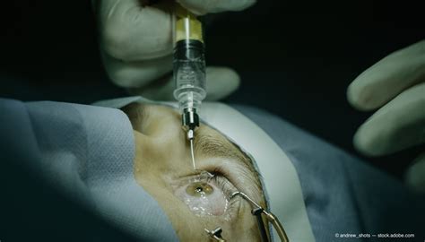 Improve Patient Comfort With Intravitreal Injections Ophthalmology Times