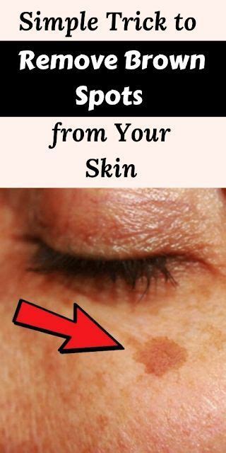 Simple Trick To Remove Brown Spots From Your Skin Healthcare Important