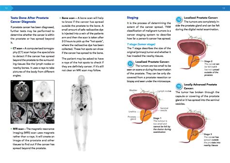 A Medical Guidebook For Prostate Cancer Patients