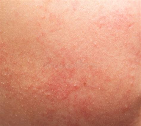 Skin Allergy In The Form Of Rash Stock Photo Image Of Appearance