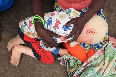 Albino People Are Being Killed For Body Parts In Malawi Time