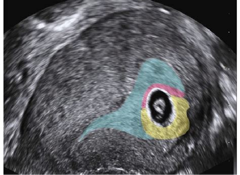 Ultrasound Image Showing The Position Of The Three Regions Of Decidua