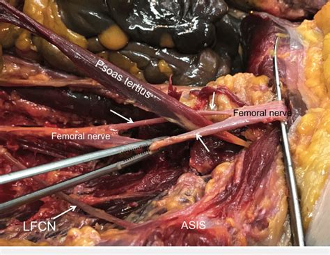 In females, the lateral ends of the fallopian tube are not covered by peritoneum, making it an open cavity. Right posterior abdominal wall of a 74-year-old female ...