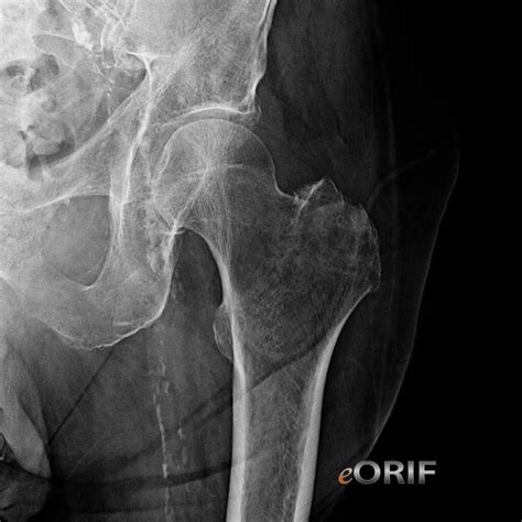 Greater Trochanter Hip Fracture S72.109A 820.20 | eORIF