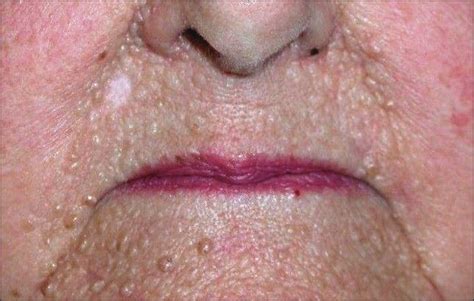 Multiple Facial Papules And Palmar Pits—diagnosis Dermatology Jama
