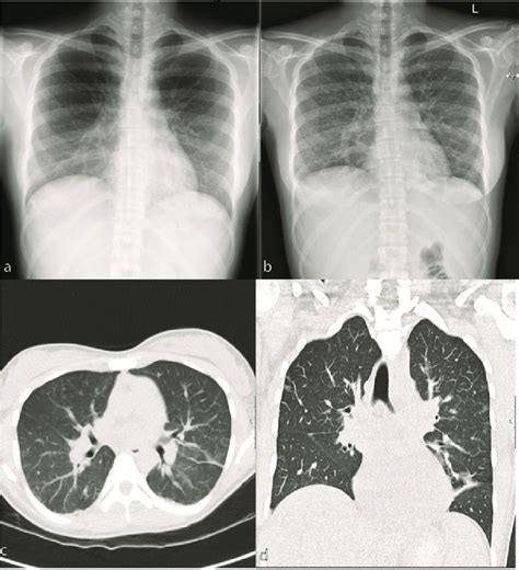 A Chest X Ray Showing Right Middle Lobe Pneumonia B Chest X Ray