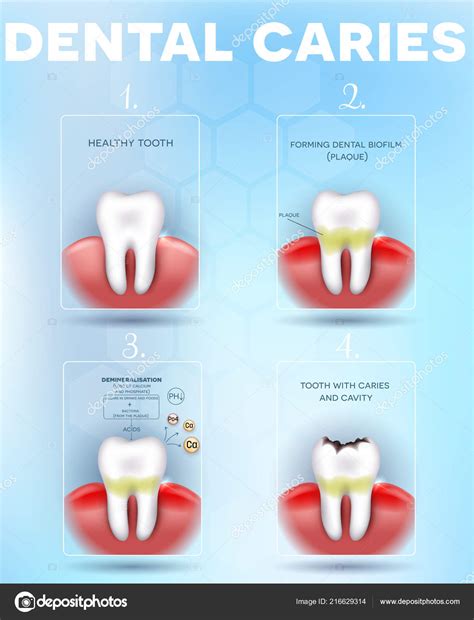 Tooth Decay Dental Caries Formation Detailed Diagram Dental Plaque Loss